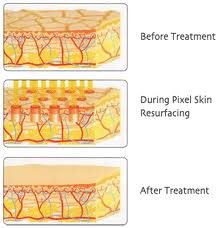 Svetlana Skin Secrets, fractional skin resurfacing